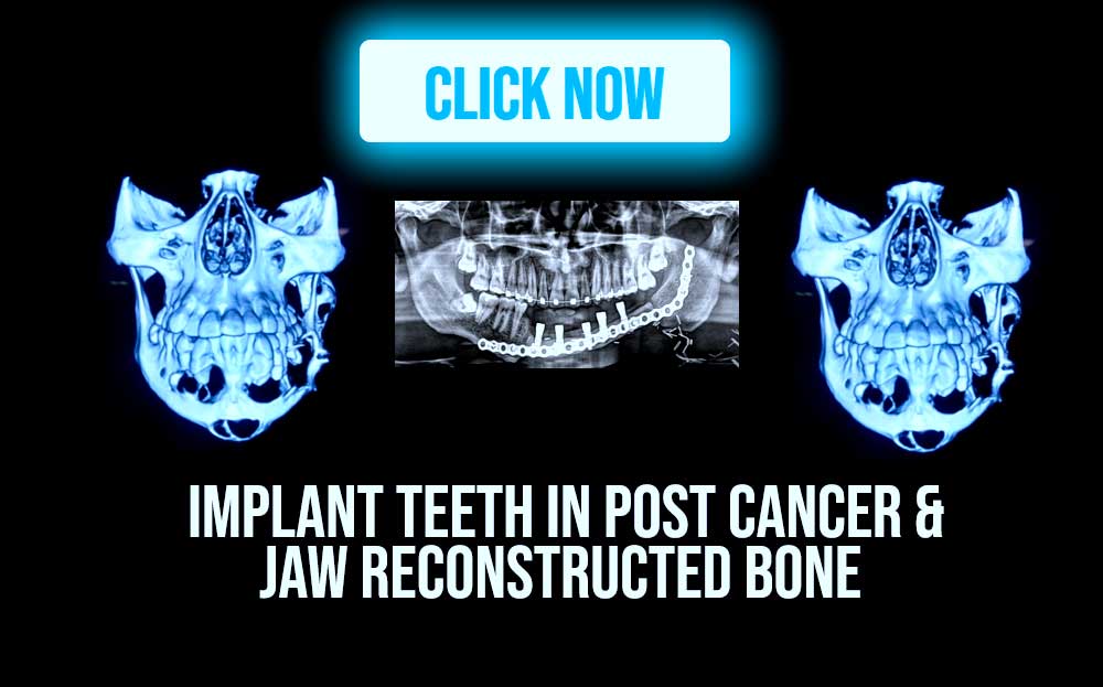 jaw reconstruction and dental implants in post-cancer patients at Dr. Sudhakar Reddy's