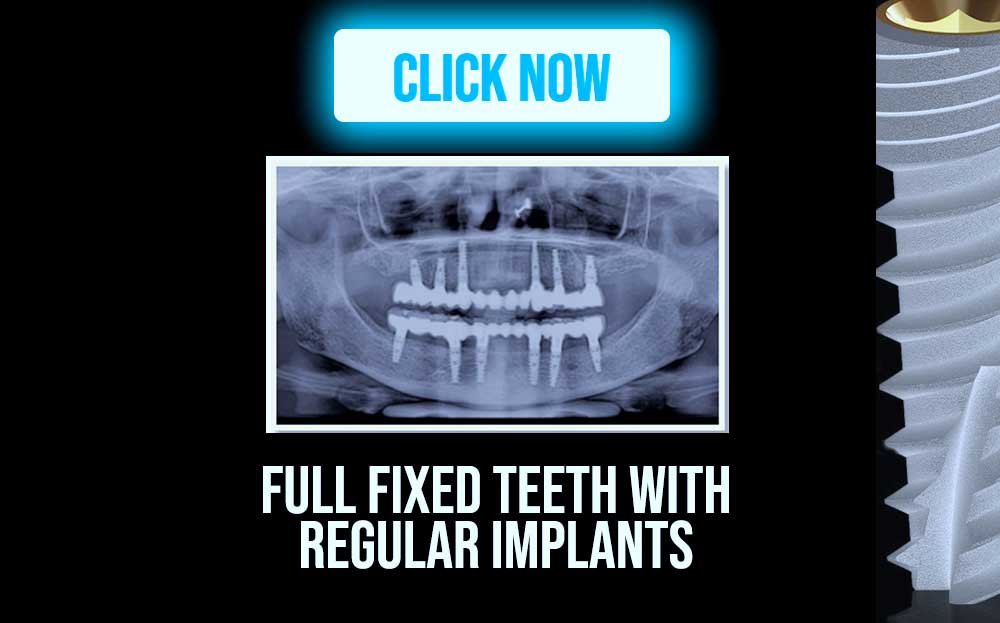 Full mouth fixed teeth with Regular implants