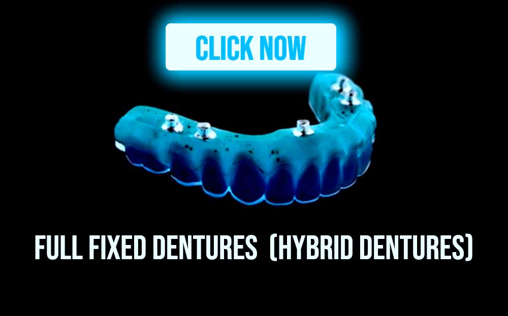 Full fixed dentures (Hybrid dentures)