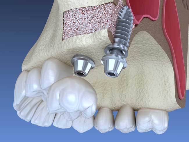 Dental implant with bone grafting for jaw reconstruction, implant placement and graft material at Dr. Sudhakar Reddy's