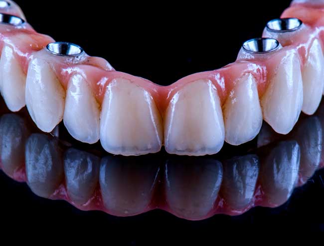 Full mouth fixed ceramic teeth with All-on-6 or All-on-8 implants at Dr. Sudhakar Reddy’s Dental Implant Studio in Bangalore