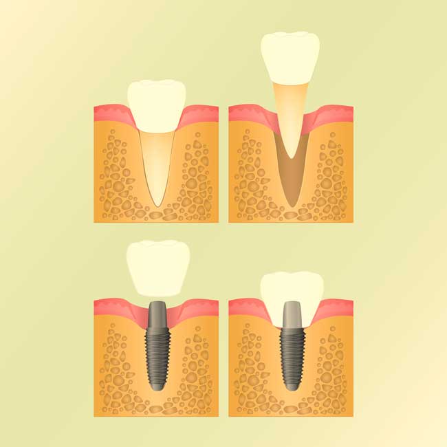 Immediate Implants Along With Teeth Removal @ Dr, Sudhakar Reddy's Dental Implant Studio