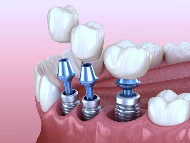 Multiple tooth replacements with dental implants in Bangalore