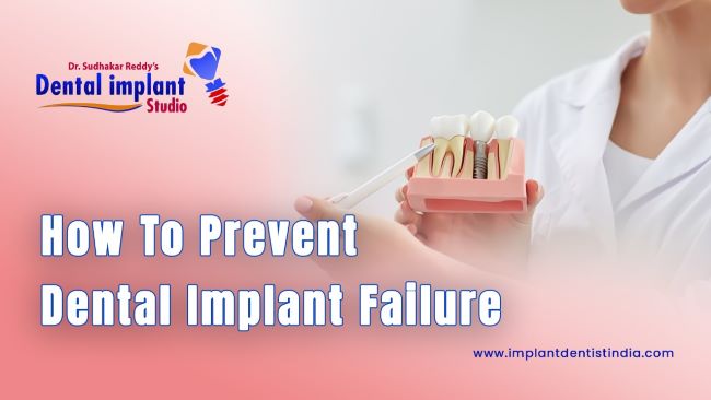 How to prevent dental implant failure at Dr. Sudhakar Reddy's Dental Implant Studio