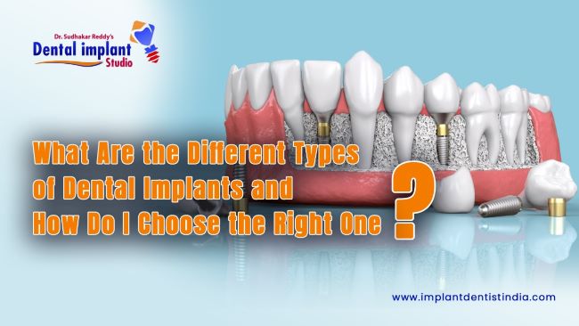 What Are the Different Types of Dental Implants and How Do I Choose the Right One?