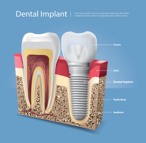 Are dental implants applicable to cancer patients?