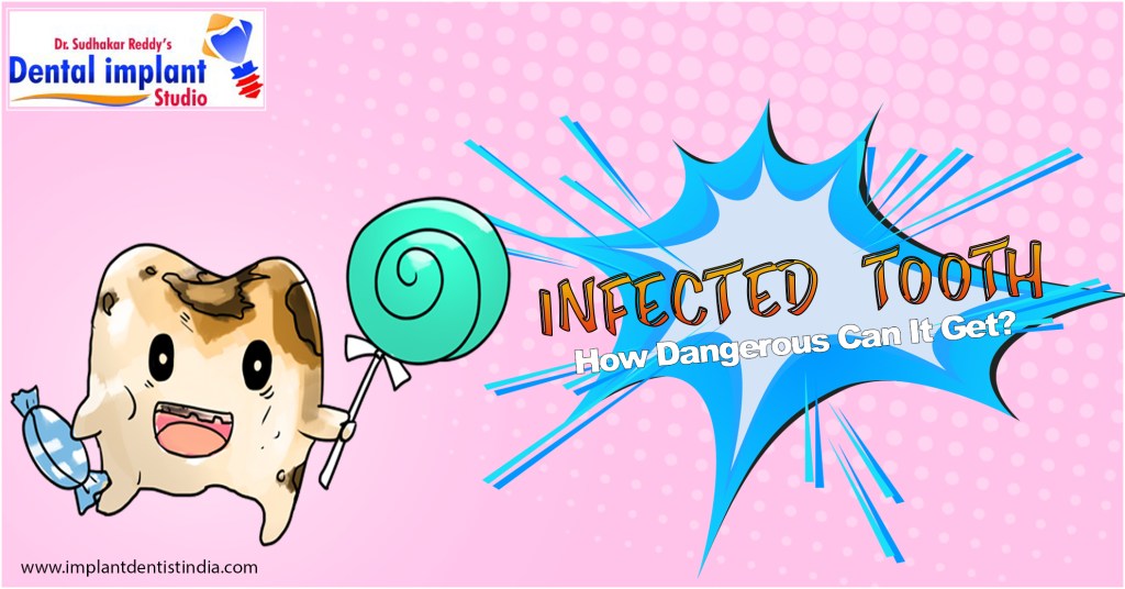 Infected tooth treatment at Dr. Sudhakar Reddy's Dental Implant Studio