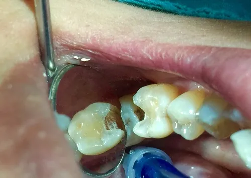Infected tooth treatment in Bangalore at Dr. Sudhakar Reddy
