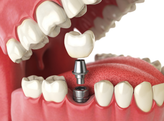 Dental Implant in Bangalore @ Dr. Sudhakar Reddy's Dental Implant Studio
