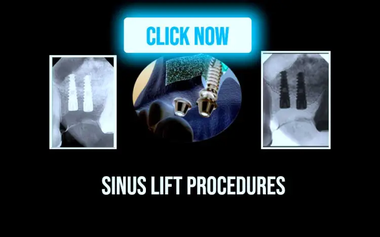 Sinus lift procedures