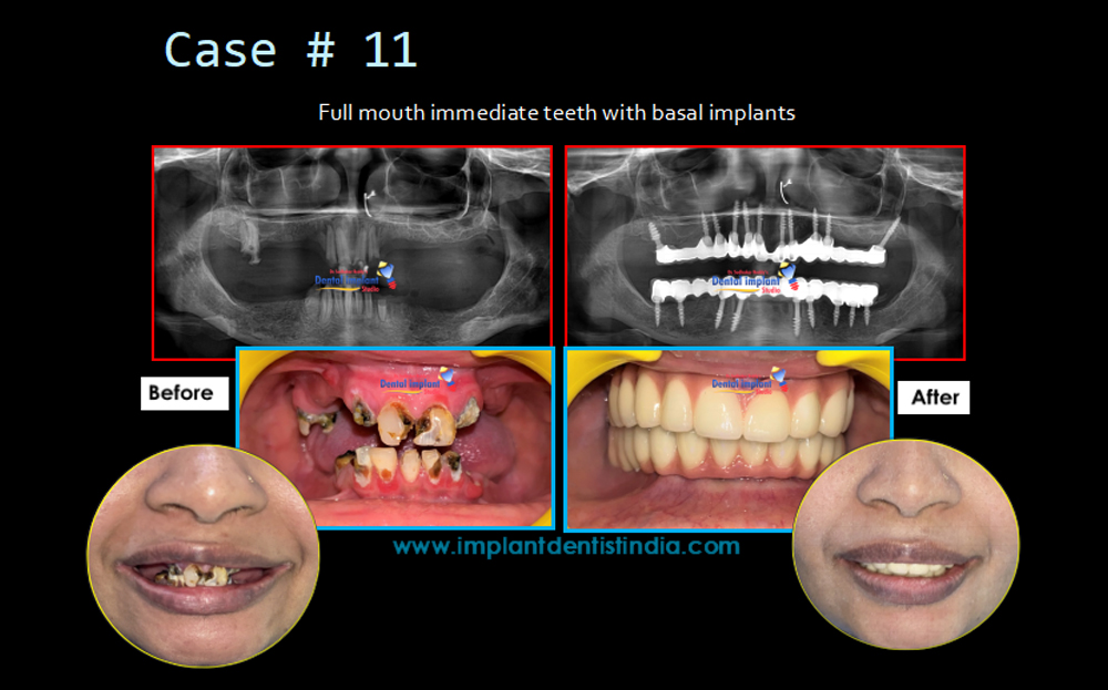 Full mouth immediate teeth with basal implants before and after treatment at Dr. Sudhakar Reddy
