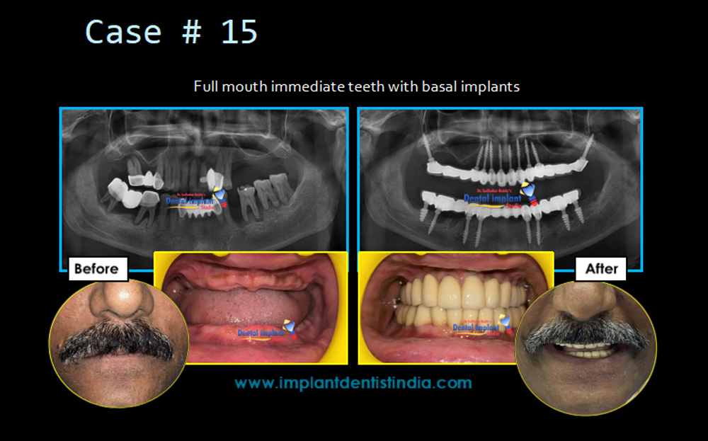 Full mouth immediate teeth restoration with basal implants at Dr. Sudhakar Reddy