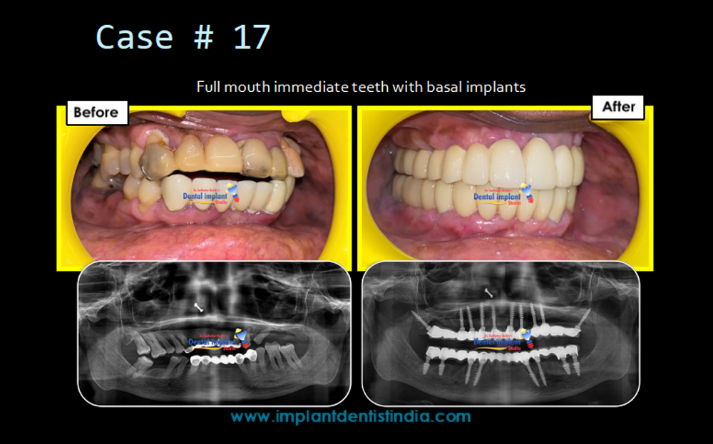 Full mouth immediate teeth with basal implants in Bangalore: before and after treatment