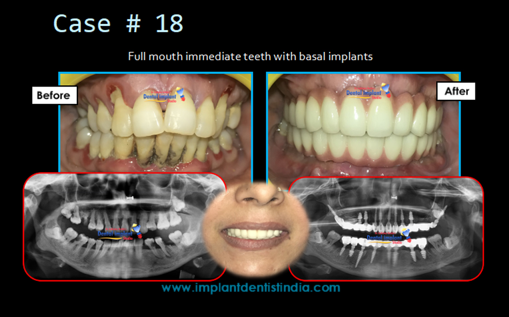 Before and after treatment of full mouth immediate teeth restoration with basal implants at Dr. Sudhakar Reddy