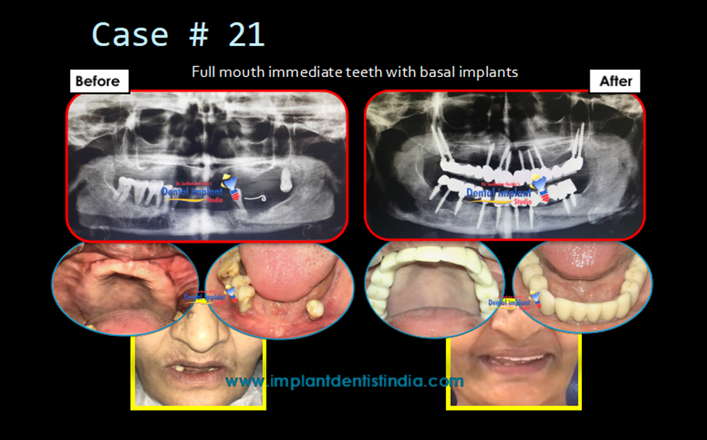 Full mouth immediate teeth rehabilitation with basal implants, before and after, at Dr. Sudhakar Reddy
