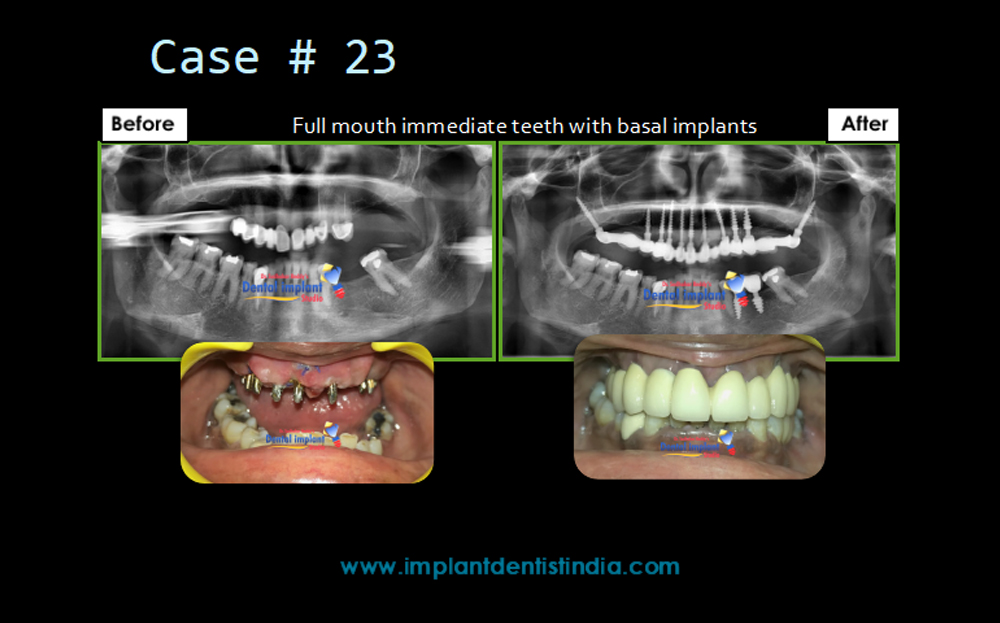 Before and after of full mouth immediate teeth replacement with basal implants at Dr. Sudhakar Reddy