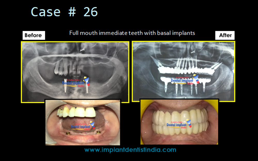 Before and after treatment of full mouth immediate teeth replacement with basal implants at Dr. Sudhakar Reddy