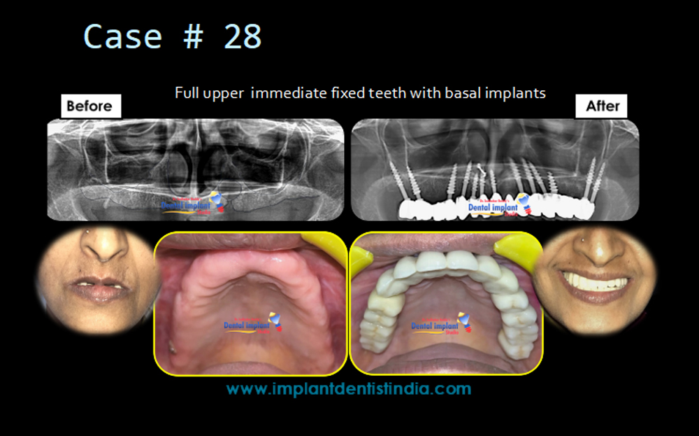 Full upper immediate fixed teeth with basal implants in Bangalore, before and after treatment