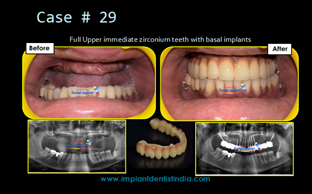 Full upper immediate zirconium teeth with basal implants in Bangalore at Dr. Sudhakar Reddy