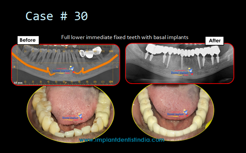 Full lower immediate fixed teeth with basal implants before and after treatment