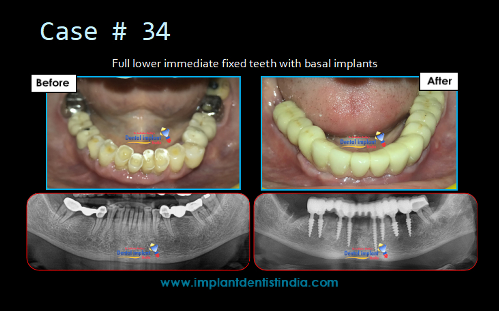 Full lower immediate fixed teeth with basal implants, before and after treatment at Dental Implant Studio