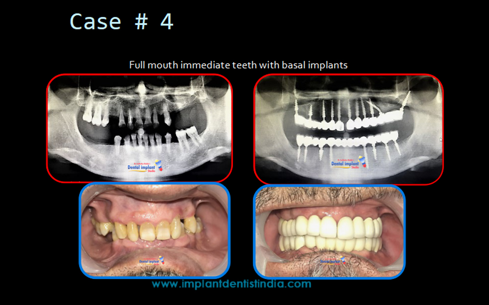 Full mouth immediate teeth with basal implants treatment at Dr. Sudhakar Reddy