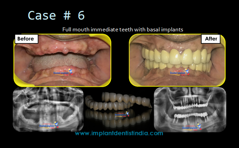 Full mouth immediate teeth with basal implants at Dr. Sudhakar Reddy's Dental Implant Studio