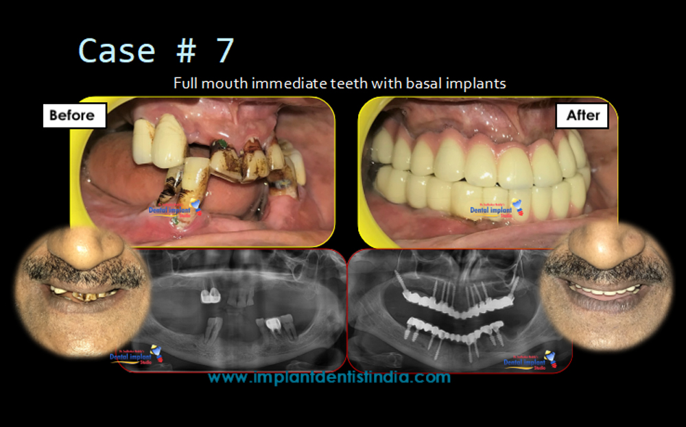 Full mouth immediate teeth with basal implants in Bangalore at Dr. Sudhakar Reddy