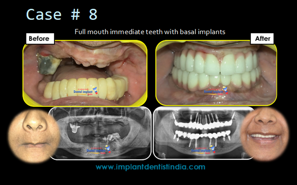 Full mouth immediate teeth with basal implants in Bangalore at Dr. Sudhakar Reddy