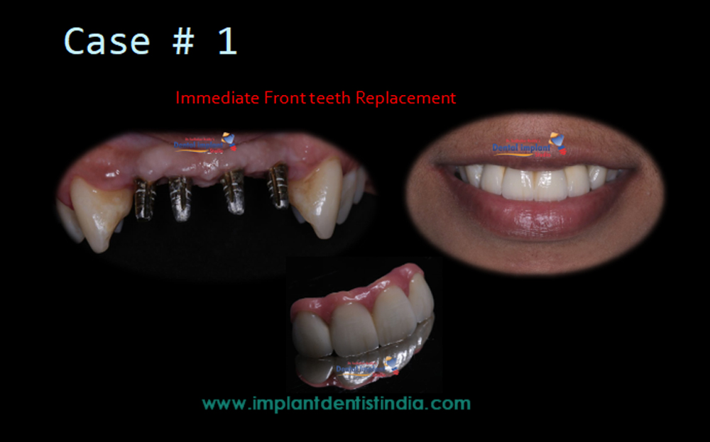 Immediate front teeth replacement treatment at Dr. Sudhakar Reddy's Dental Implant Studio