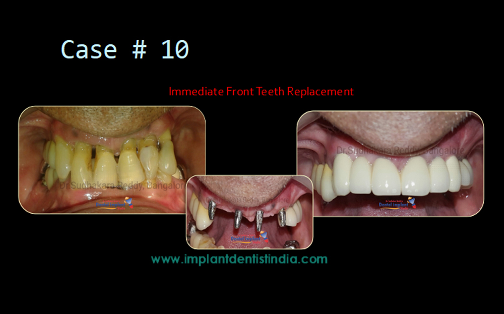 Immediate lower front teeth restoration treatment at Dr. Sudhakar Reddy's Dental Implant Studio