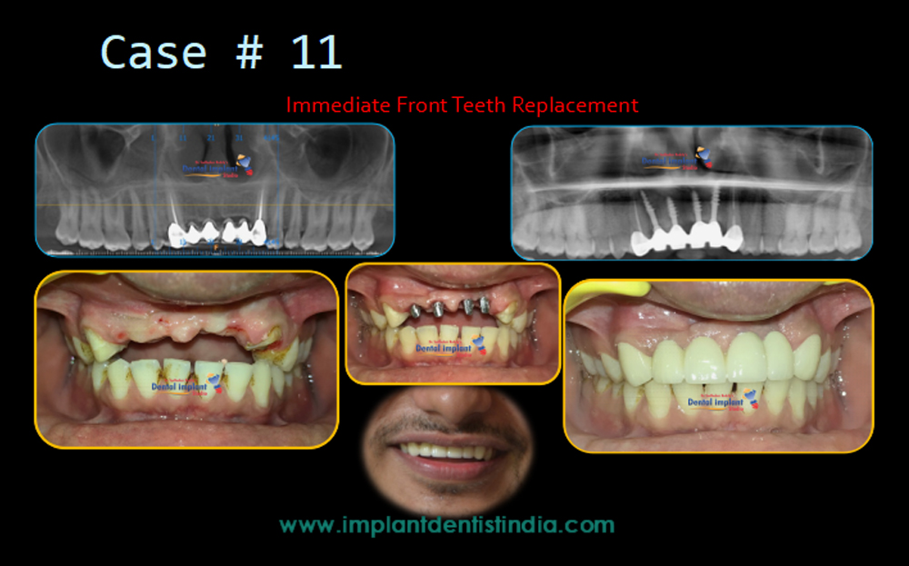 Immediate front teeth replacement treatment at Dr. Sudhakar Reddy's Dental Implant Studio
