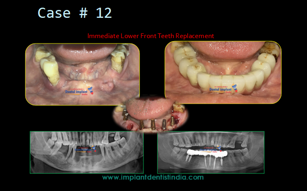 Immediate lower front teeth replacement at Dr. Sudhakar Reddy's Dental Implant Studio