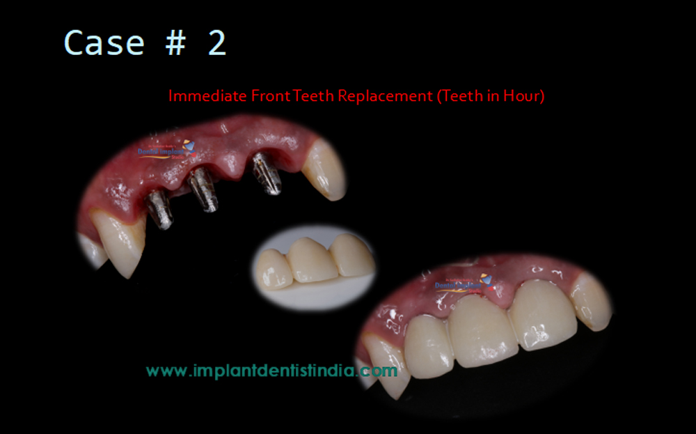 Immediate front teeth reconstruction (Teeth in an Hour) treatment at Dr. Sudhakar Reddy