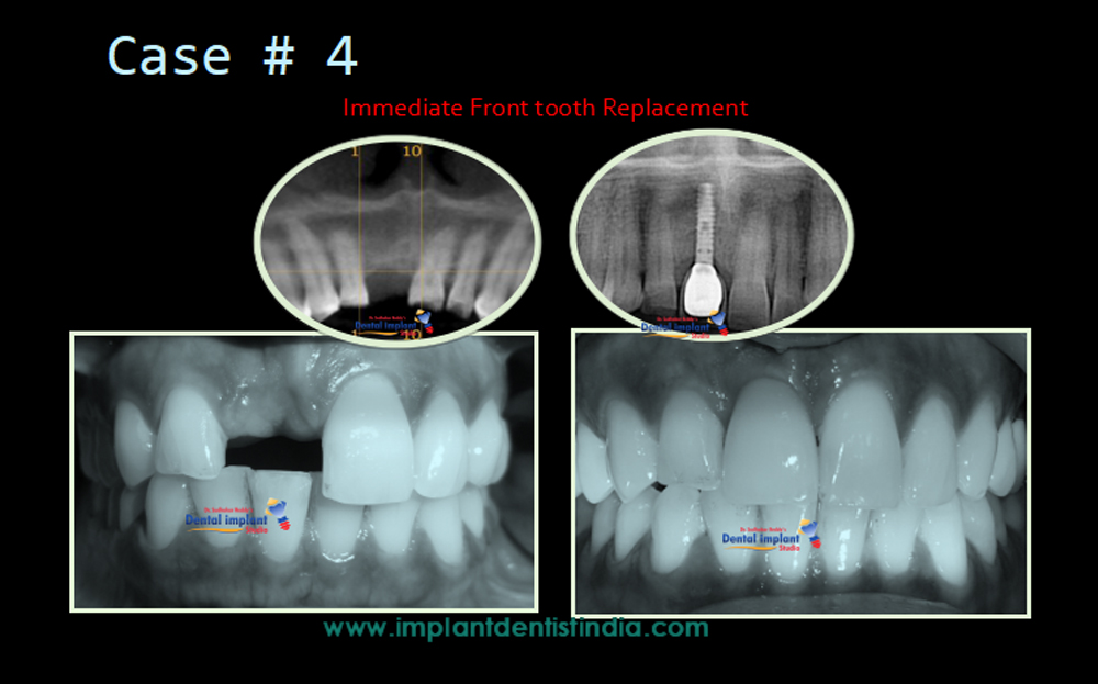 Immediate front tooth replacement at Dr. Sudhakar Reddy's Dental Implant Studio