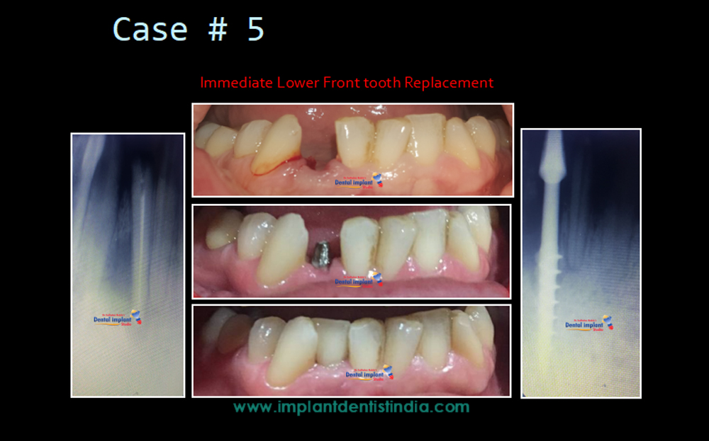 Immediate lower front tooth replacement at Dr. Sudhakar Reddy's Dental Implant Studio