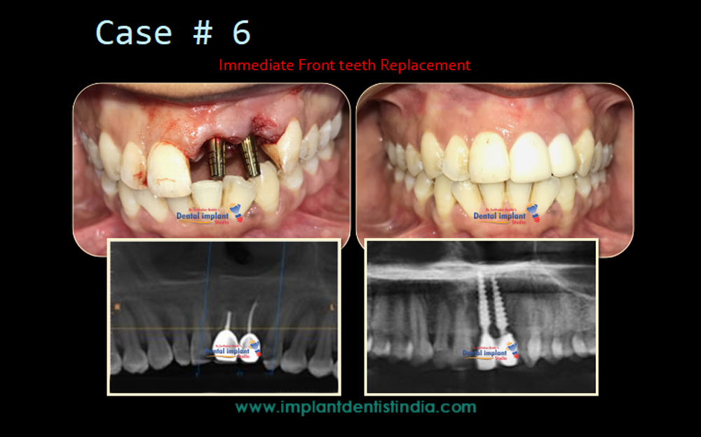 Before and after treatment of immediate front teeth replacement at Dr. Sudhakar Reddy