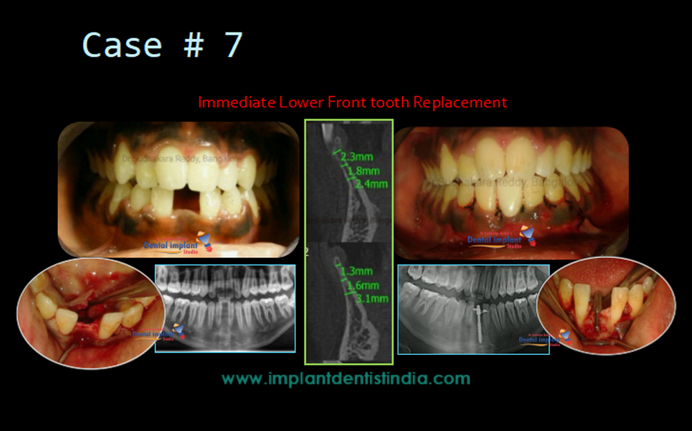 Immediate lower front tooth replacement treatment in Bangalore at Dr. Sudhakar Reddy