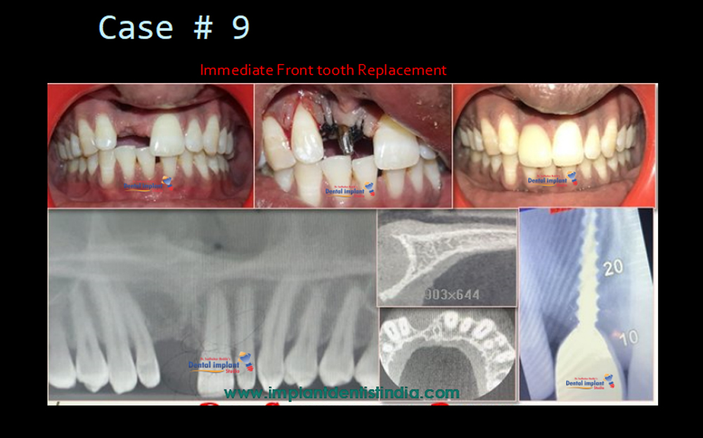 Immediate front tooth replacement: before and after, and implant procedure at Dr. Sudhakar Reddy