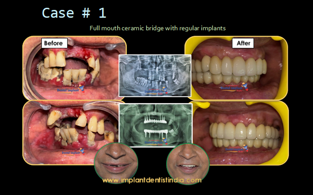 Full mouth ceramic bridge with regular implants before and after treatment at Dr. Sudhakar Reddy