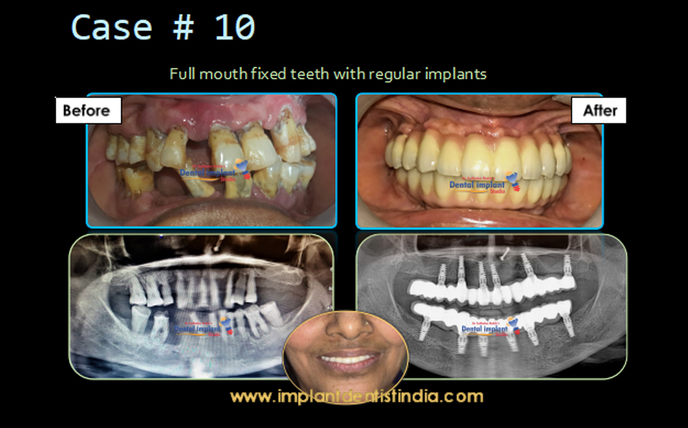 Full mouth fixed teeth with regular implants case before and after treatment at Dr. Sudhakar Reddy