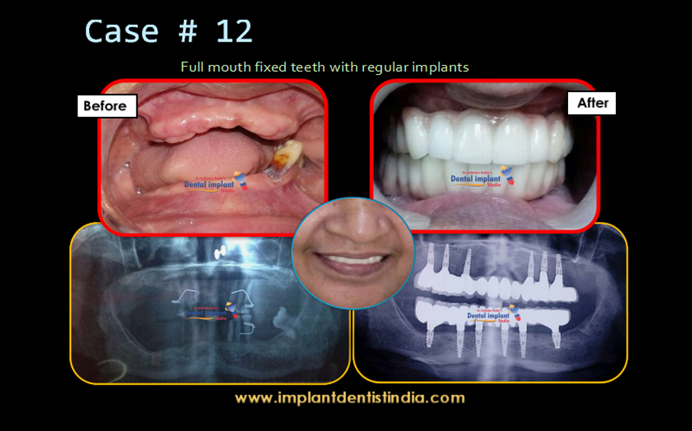 Full mouth fixed teeth with regular implants before and after treatment at Dr. Sudhakar Reddy