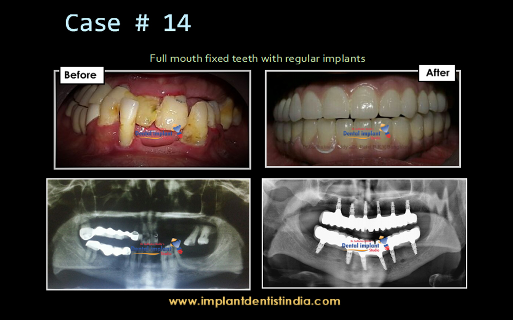 Before and after of full mouth fixed teeth with regular implants at Dr. Sudhakar Reddy