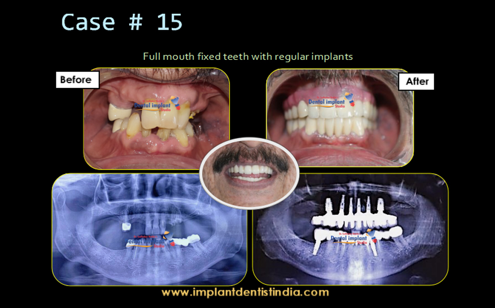 Full mouth fixed teeth with regular implants in Bangalore at Dr. Sudhakar Reddy's Dental Implant Studio