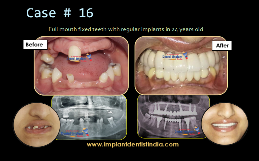 Full mouth fixed teeth with regular implants for a 24-year-old at Dr. Sudhakar Reddy's Dental Implant Studio