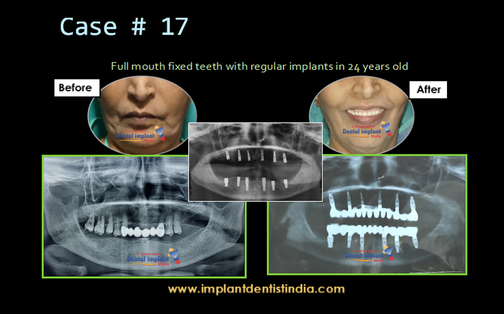 Full mouth fixed teeth with regular implants 24 years old at Dr. Sudhakar Reddy