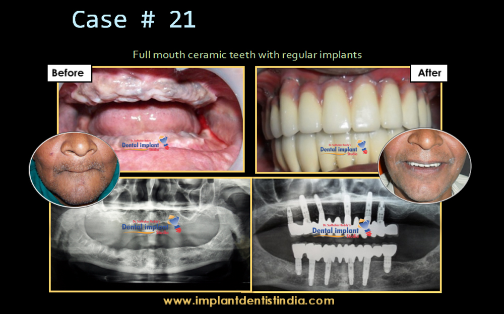 Full upper ceramic teeth with regular implants at Dr. Sudhakar Reddy's Dental Implants