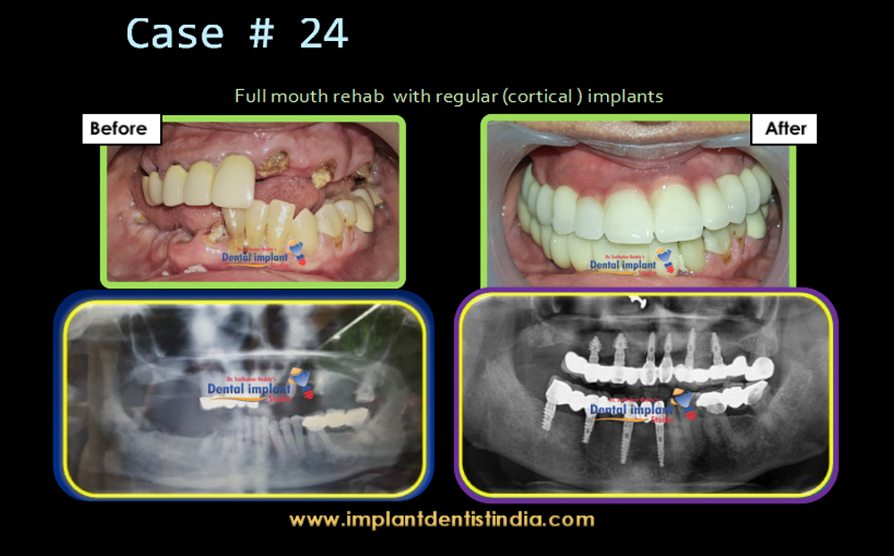 Full mouth rehab with regular implant at Dr. Sudhakar Reddy's Dental Implant Studio