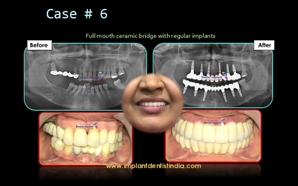 Full mouth ceramic bridge with regular implants in Bangalore before and after treatment at Dr. Sudhakar Reddy
