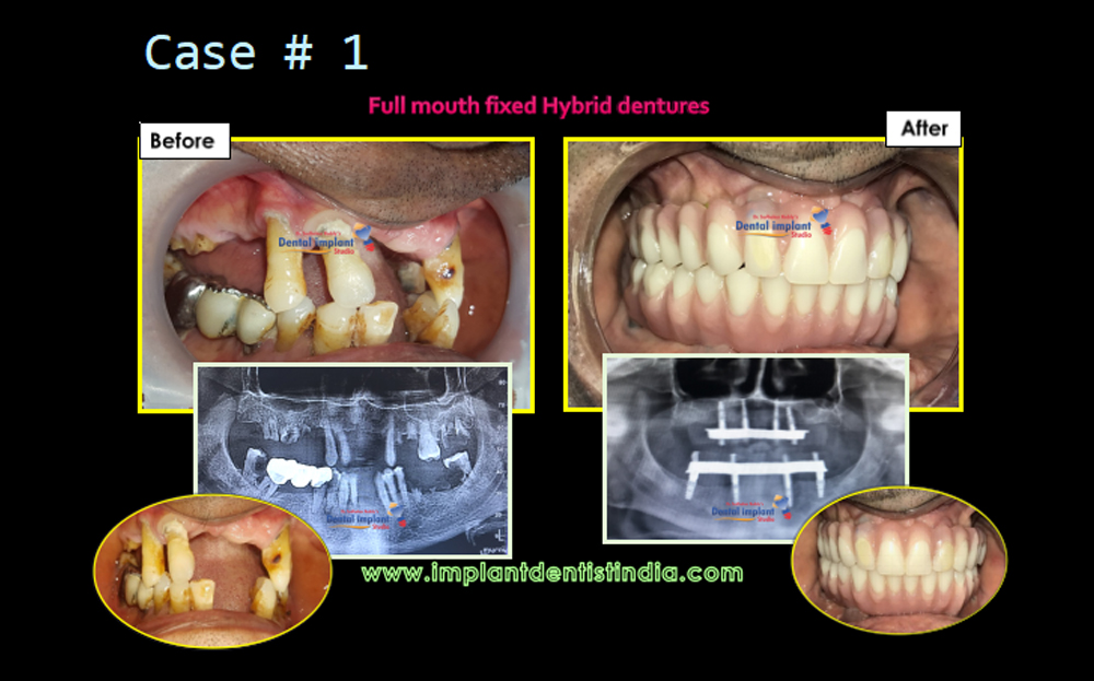 Full mouth fixed hybrid dentures before and after at Dr. Sudhakar Reddy's Dental Implant Studio